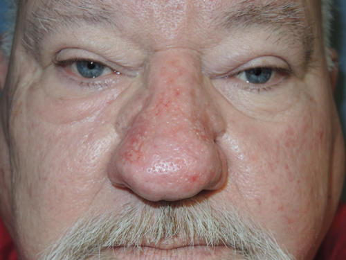 Rhinophyma