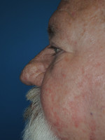 Rhinophyma