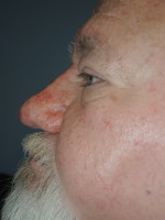 Rhinophyma