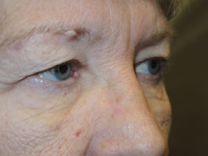 Functional Upper Eyelid Blepharoplasty