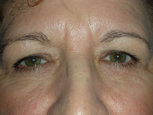 Functional Upper Eyelid Blepharoplasty