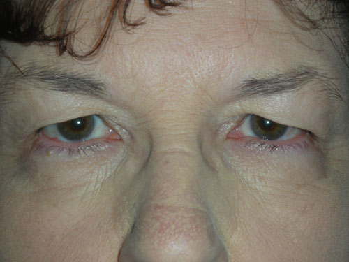 Functional Upper Eyelid Blepharoplasty