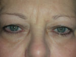 Functional Upper Eyelid Blepharoplasty