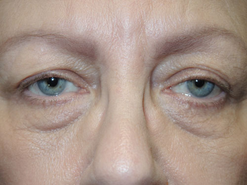 Functional Ptosis Repair