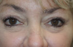 Cosmetic Upper Eyelid Blepharoplasty