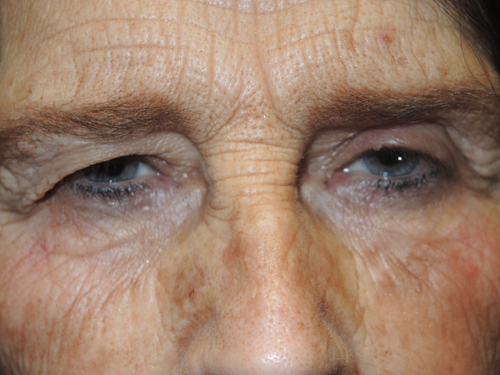 Functional Upper Eyelid Blepharoplasty