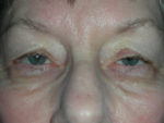 Functional Ptosis Repair