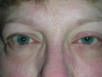 Functional Ptosis Repair