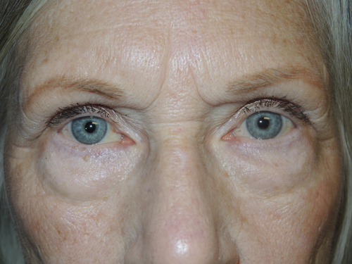 Lower Eyelid Blepharoplasty