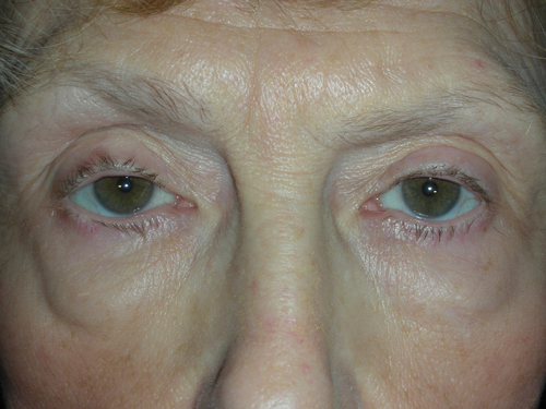 Lower Eyelid Blepharoplasty