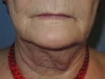 Laser Resurfacing