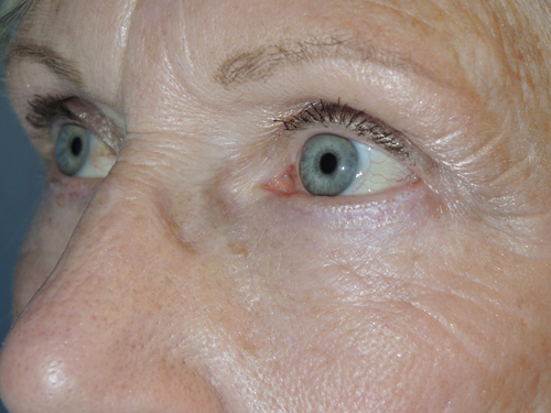 Lower Eyelid Blepharoplasty