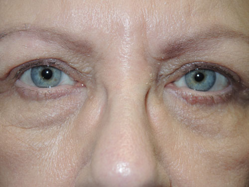 Functional Ptosis Repair