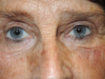 Functional Upper Eyelid Blepharoplasty