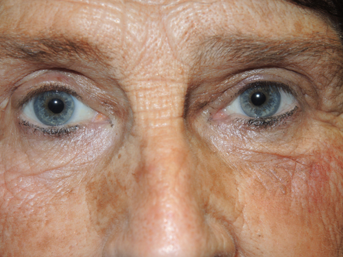 Functional Upper Eyelid Blepharoplasty