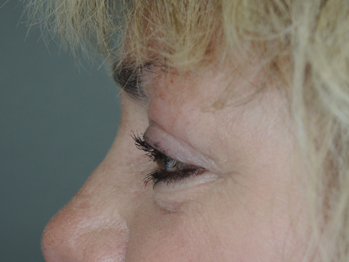 Cosmetic Upper Eyelid Blepharoplasty