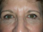 Functional Upper Eyelid Blepharoplasty