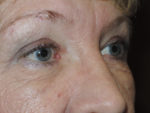 Functional Upper Eyelid Blepharoplasty