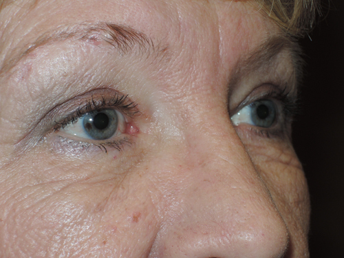 Functional Upper Eyelid Blepharoplasty