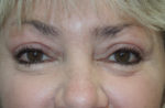 Cosmetic Upper Eyelid Blepharoplasty