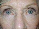 Lower Eyelid Blepharoplasty