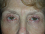 Lower Eyelid Blepharoplasty