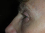 Lower Eyelid Blepharoplasty