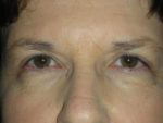 Functional Upper Eyelid Blepharoplasty