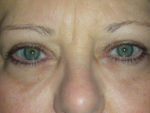 Functional Upper Eyelid Blepharoplasty