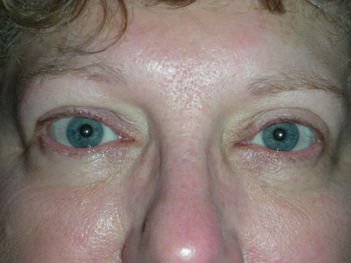 Functional Ptosis Repair