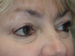 Cosmetic Upper Eyelid Blepharoplasty