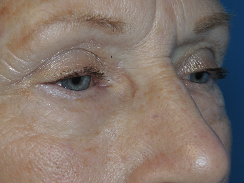 Lower Eyelid Blepharoplasty