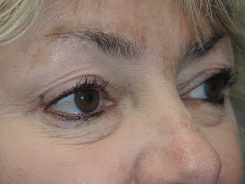 Cosmetic Upper Eyelid Blepharoplasty