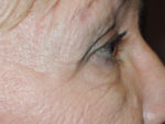 Functional Upper Eyelid Blepharoplasty