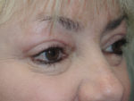 Cosmetic Upper Eyelid Blepharoplasty