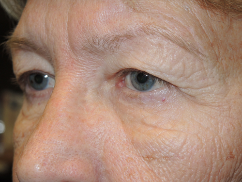 Functional Upper Eyelid Blepharoplasty