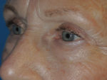 Lower Eyelid Blepharoplasty