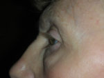 Lower Eyelid Blepharoplasty