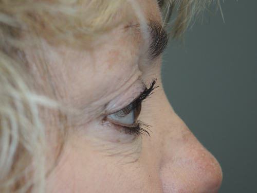 Cosmetic Upper Eyelid Blepharoplasty