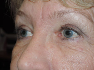 Functional Upper Eyelid Blepharoplasty