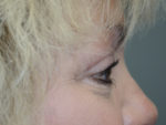 Cosmetic Upper Eyelid Blepharoplasty