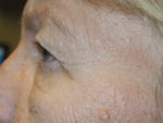 Functional Upper Eyelid Blepharoplasty