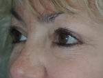 Cosmetic Upper Eyelid Blepharoplasty