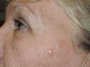 Functional Upper Eyelid Blepharoplasty