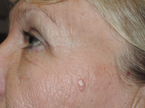 Functional Upper Eyelid Blepharoplasty