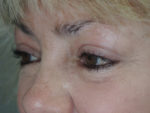 Cosmetic Upper Eyelid Blepharoplasty