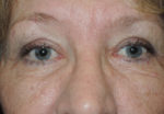 Functional Upper Eyelid Blepharoplasty