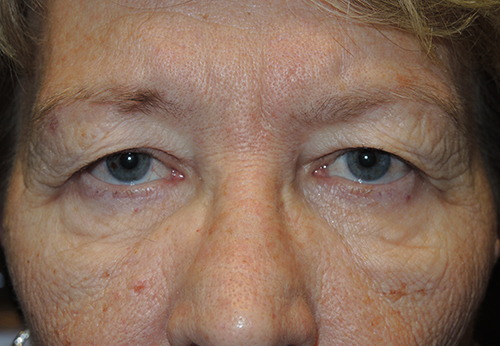 Functional Upper Eyelid Blepharoplasty