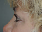 Cosmetic Upper Eyelid Blepharoplasty