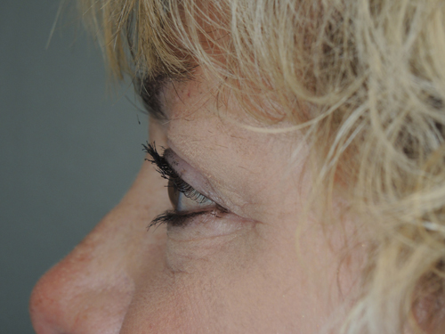 Cosmetic Upper Eyelid Blepharoplasty